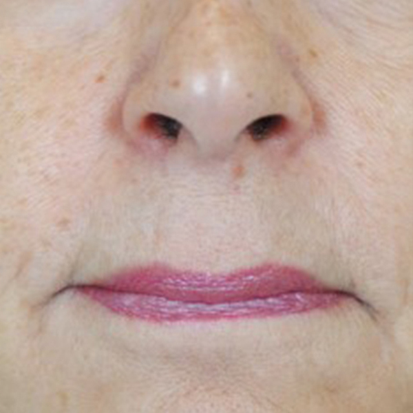 Lip Lift Before and After | Thomas Funcik MD