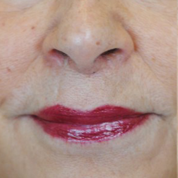 Lip Lift Before and After | Thomas Funcik MD