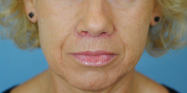 Lip Lift Before and After | Thomas Funcik MD