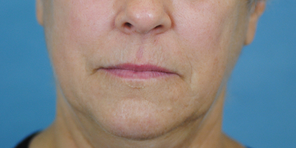 Lip Lift Before and After | Thomas Funcik MD