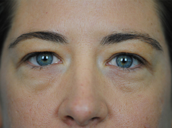 Eyelid Lift Charleston