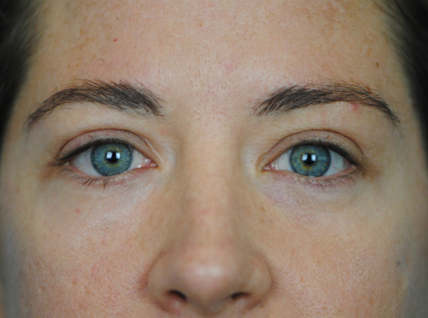 Lowcountry Lid Lift Blepharoplasty Before and After | Thomas Funcik MD