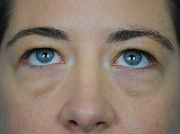 Lowcountry Lid Lift Blepharoplasty Before and After | Thomas Funcik MD