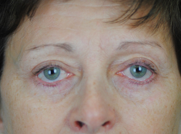 Eyelid Lift Charleston