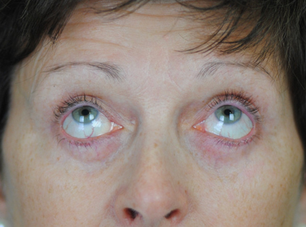 Lowcountry Lid Lift Blepharoplasty Before and After | Thomas Funcik MD