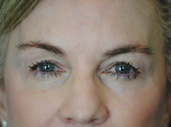 Lowcountry Lid Lift Blepharoplasty Before and After | Thomas Funcik MD