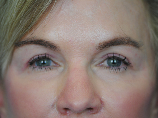 Lowcountry Lid Lift Blepharoplasty Before and After | Thomas Funcik MD