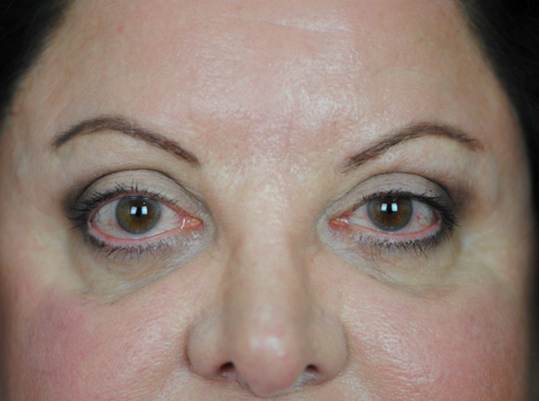 Lowcountry Lid Lift Blepharoplasty Before and After | Thomas Funcik MD