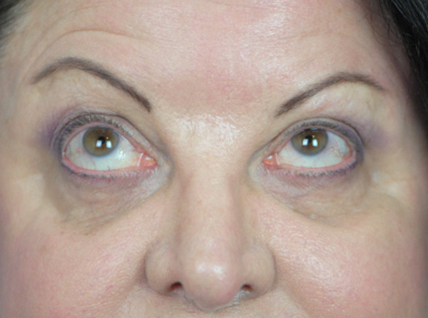 Lowcountry Lid Lift Blepharoplasty Before and After | Thomas Funcik MD