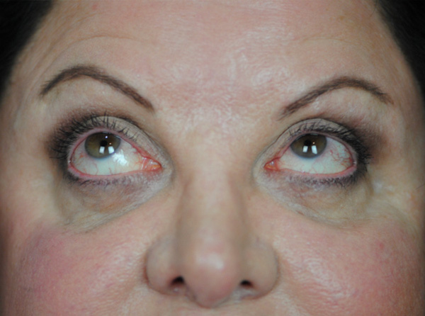 Lowcountry Lid Lift Blepharoplasty Before and After | Thomas Funcik MD