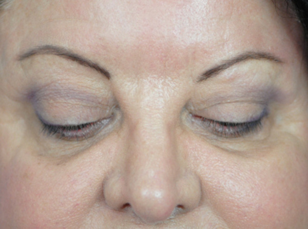 Lowcountry Lid Lift Blepharoplasty Before and After | Thomas Funcik MD