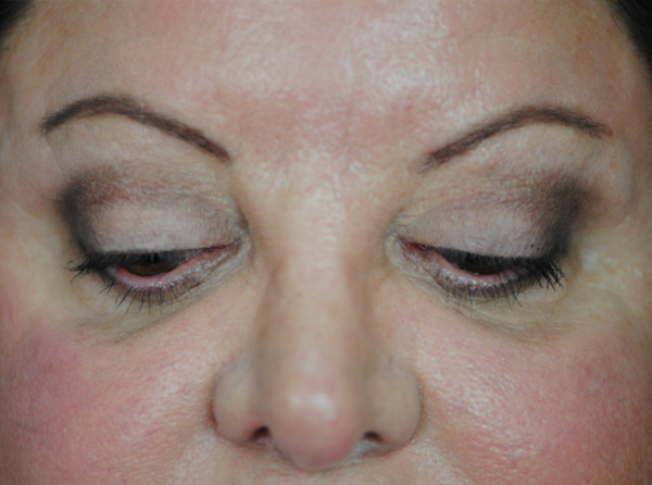 Lowcountry Lid Lift Blepharoplasty Before and After | Thomas Funcik MD