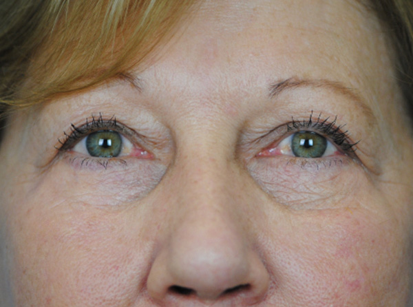 Lowcountry Lid Lift Blepharoplasty Before and After | Thomas Funcik MD