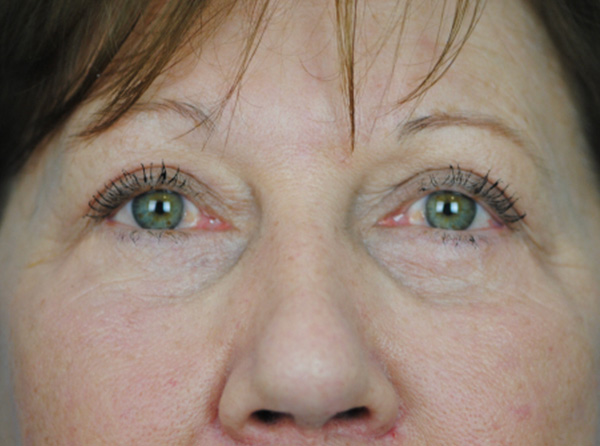 Lowcountry Lid Lift Blepharoplasty Before and After | Thomas Funcik MD