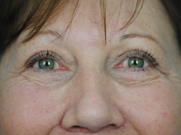 Lowcountry Lid Lift Blepharoplasty Before and After | Thomas Funcik MD