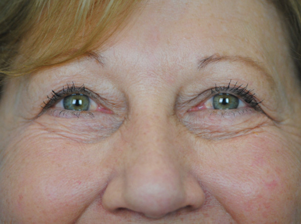 Lowcountry Lid Lift Blepharoplasty Before and After | Thomas Funcik MD