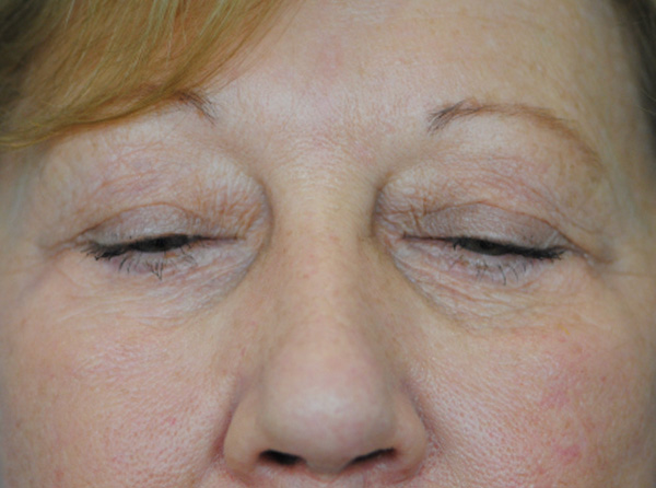 Lowcountry Lid Lift Blepharoplasty Before and After | Thomas Funcik MD