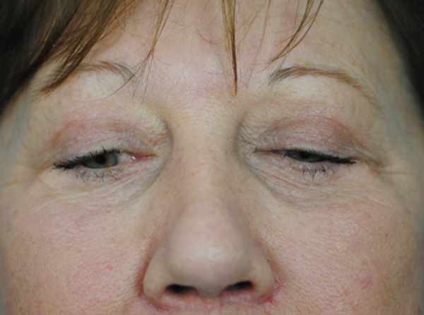 Lowcountry Lid Lift Blepharoplasty Before and After | Thomas Funcik MD