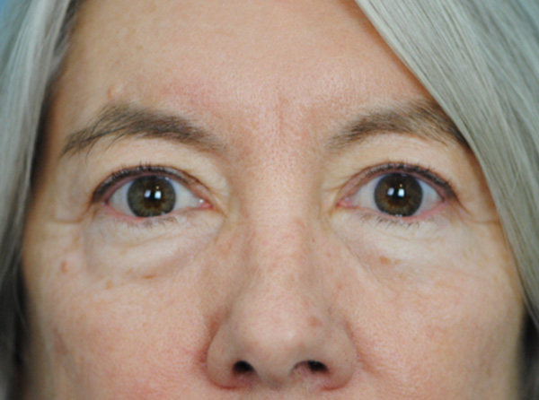 Lowcountry Lid Lift Blepharoplasty Before and After | Thomas Funcik MD