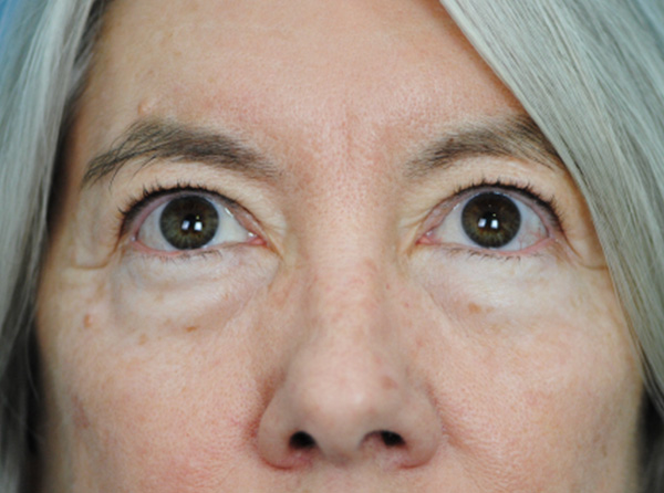 Lowcountry Lid Lift Blepharoplasty Before and After | Thomas Funcik MD