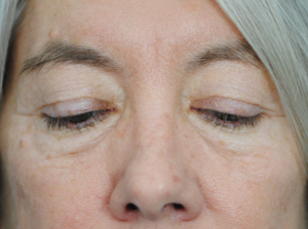 Lowcountry Lid Lift Blepharoplasty Before and After | Thomas Funcik MD