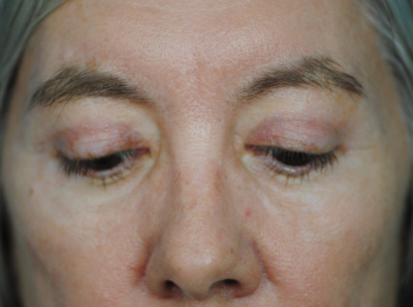 Lowcountry Lid Lift Blepharoplasty Before and After | Thomas Funcik MD