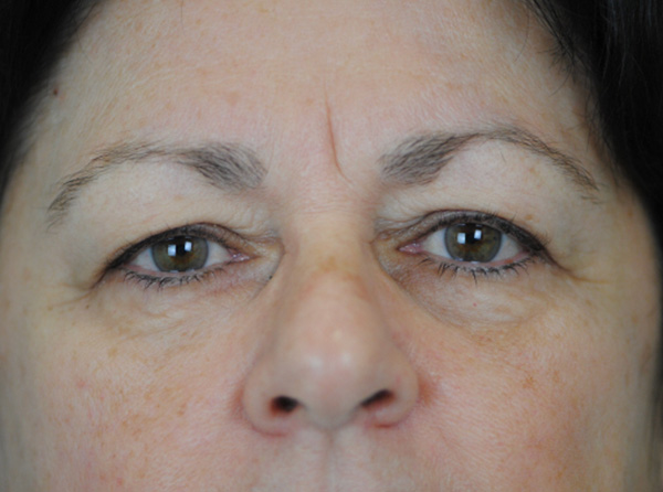 Lowcountry Lid Lift Blepharoplasty Before and After | Thomas Funcik MD