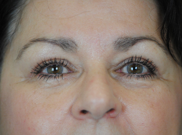 Lowcountry Lid Lift Blepharoplasty Before and After | Thomas Funcik MD