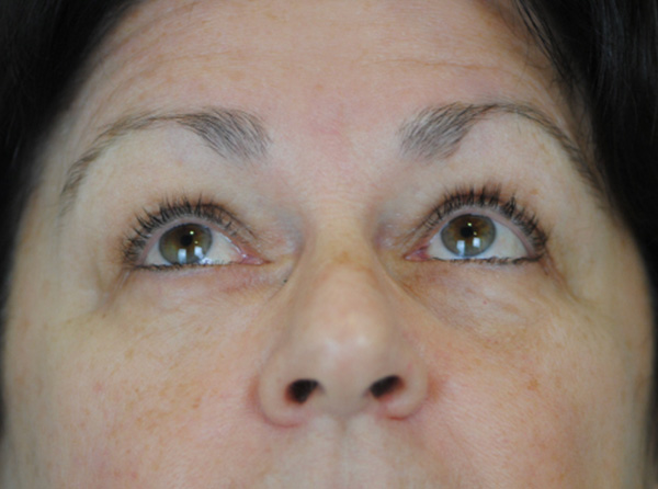 Lowcountry Lid Lift Blepharoplasty Before and After | Thomas Funcik MD