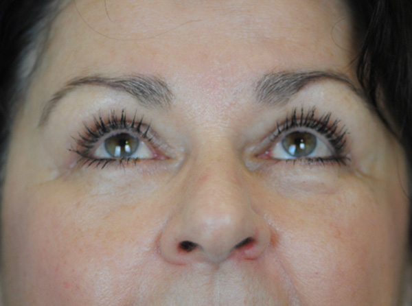 Lowcountry Lid Lift Blepharoplasty Before and After | Thomas Funcik MD