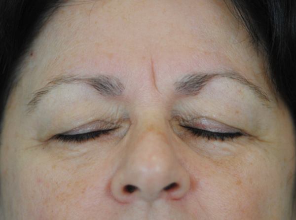 Lowcountry Lid Lift Blepharoplasty Before and After | Thomas Funcik MD