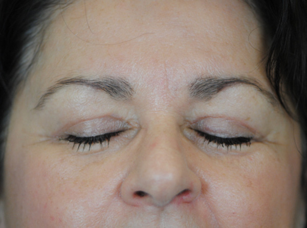 Lowcountry Lid Lift Blepharoplasty Before and After | Thomas Funcik MD