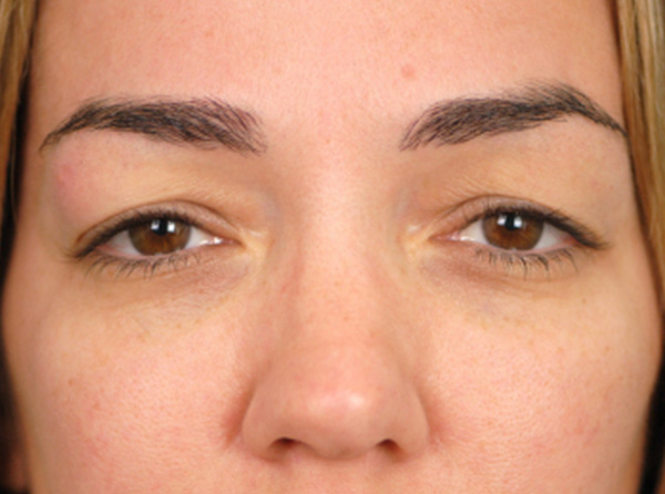 Lowcountry Lid Lift Blepharoplasty Before and After | Thomas Funcik MD