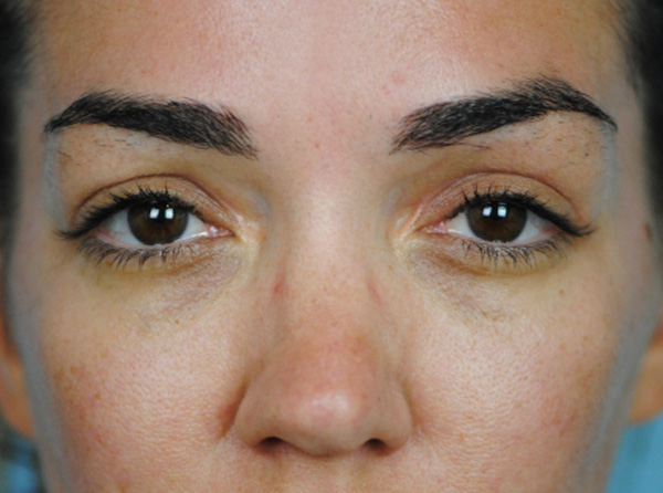 Lowcountry Lid Lift Blepharoplasty Before and After | Thomas Funcik MD