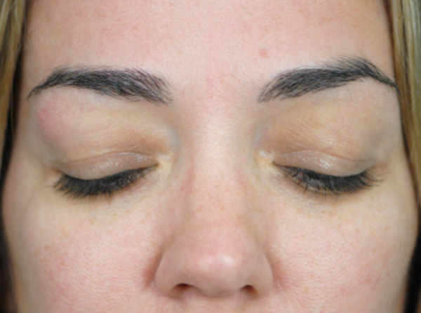 Lowcountry Lid Lift Blepharoplasty Before and After | Thomas Funcik MD