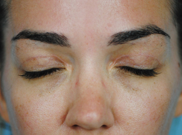 Lowcountry Lid Lift Blepharoplasty Before and After | Thomas Funcik MD