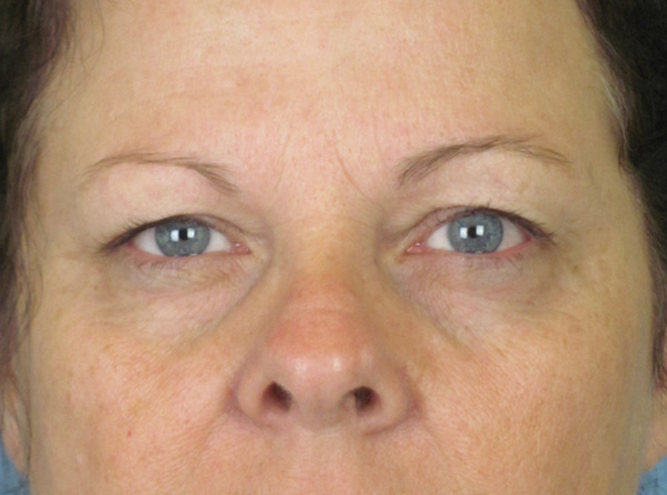 Lowcountry Lid Lift Blepharoplasty Before and After | Thomas Funcik MD