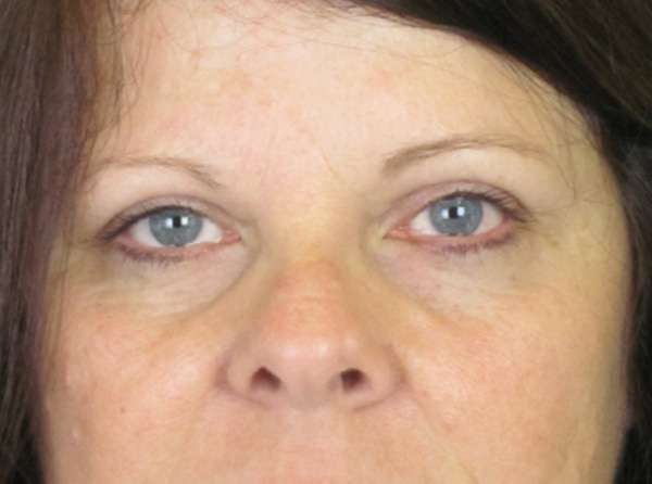 Lowcountry Lid Lift Blepharoplasty Before and After | Thomas Funcik MD