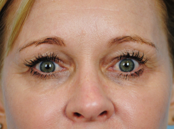 Lowcountry Lid Lift Blepharoplasty Before and After | Thomas Funcik MD