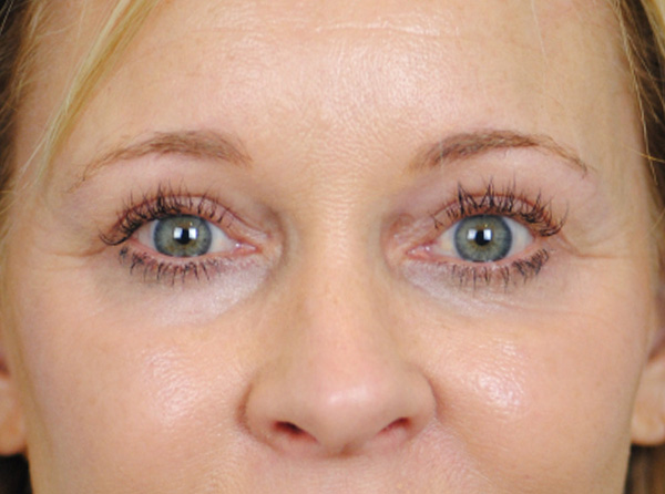 Lowcountry Lid Lift Blepharoplasty Before and After | Thomas Funcik MD