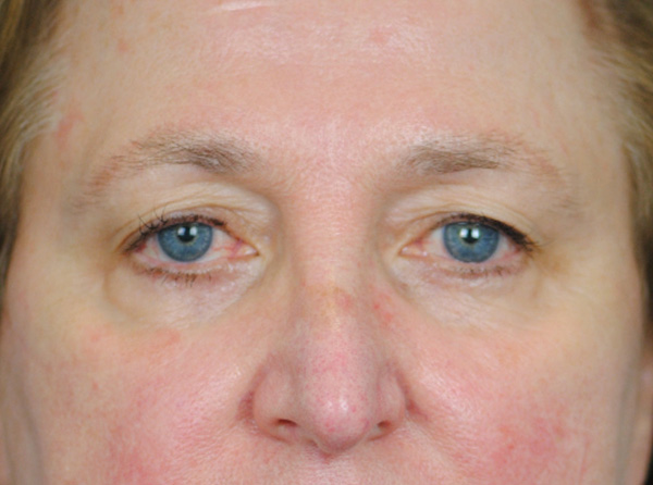 Lowcountry Lid Lift Blepharoplasty Before and After | Thomas Funcik MD