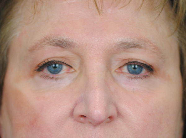 Lowcountry Lid Lift Blepharoplasty Before and After | Thomas Funcik MD