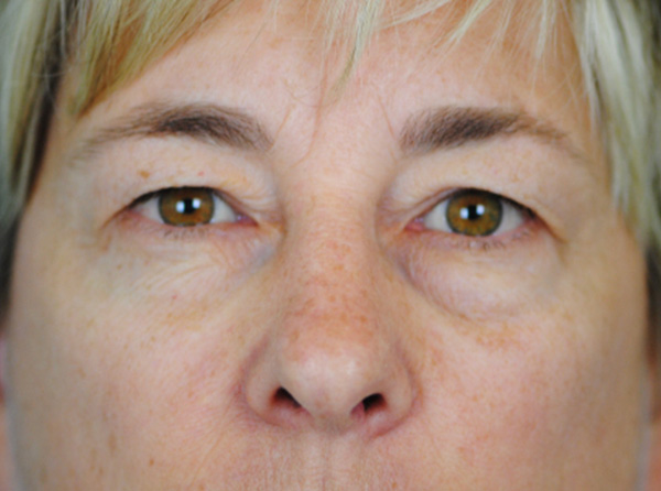 Lowcountry Lid Lift Blepharoplasty Before and After | Thomas Funcik MD