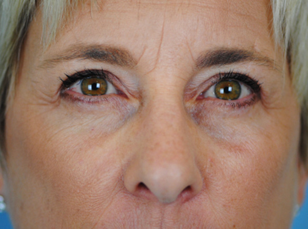 Lowcountry Lid Lift Blepharoplasty Before and After | Thomas Funcik MD