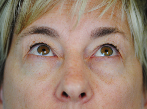 Lowcountry Lid Lift Blepharoplasty Before and After | Thomas Funcik MD