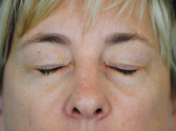 Lowcountry Lid Lift Blepharoplasty Before and After | Thomas Funcik MD