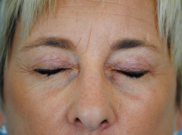 Lowcountry Lid Lift Blepharoplasty Before and After | Thomas Funcik MD