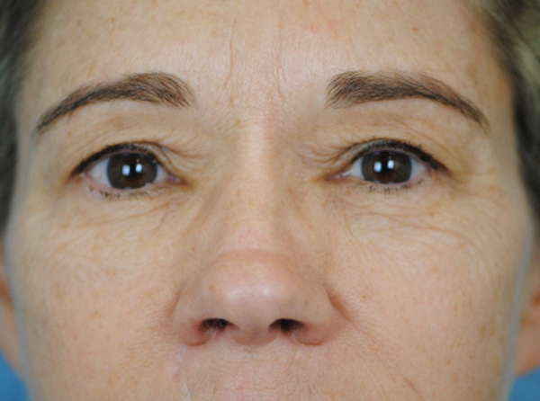 Lowcountry Lid Lift Blepharoplasty Before and After | Thomas Funcik MD