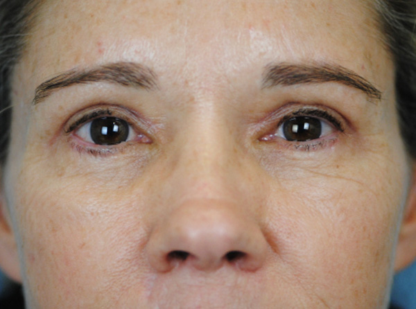 Lowcountry Lid Lift Blepharoplasty Before and After | Thomas Funcik MD