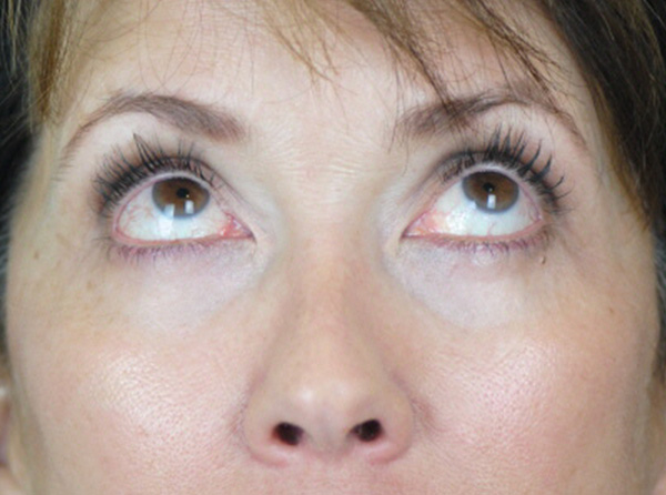 Lowcountry Lid Lift Blepharoplasty Before and After | Thomas Funcik MD